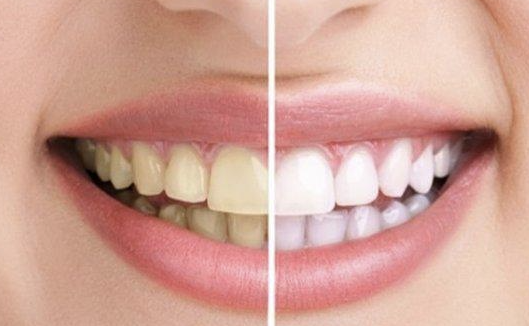 Cara Menghilangkan Gigi Kuning Secara Alami dan Medis